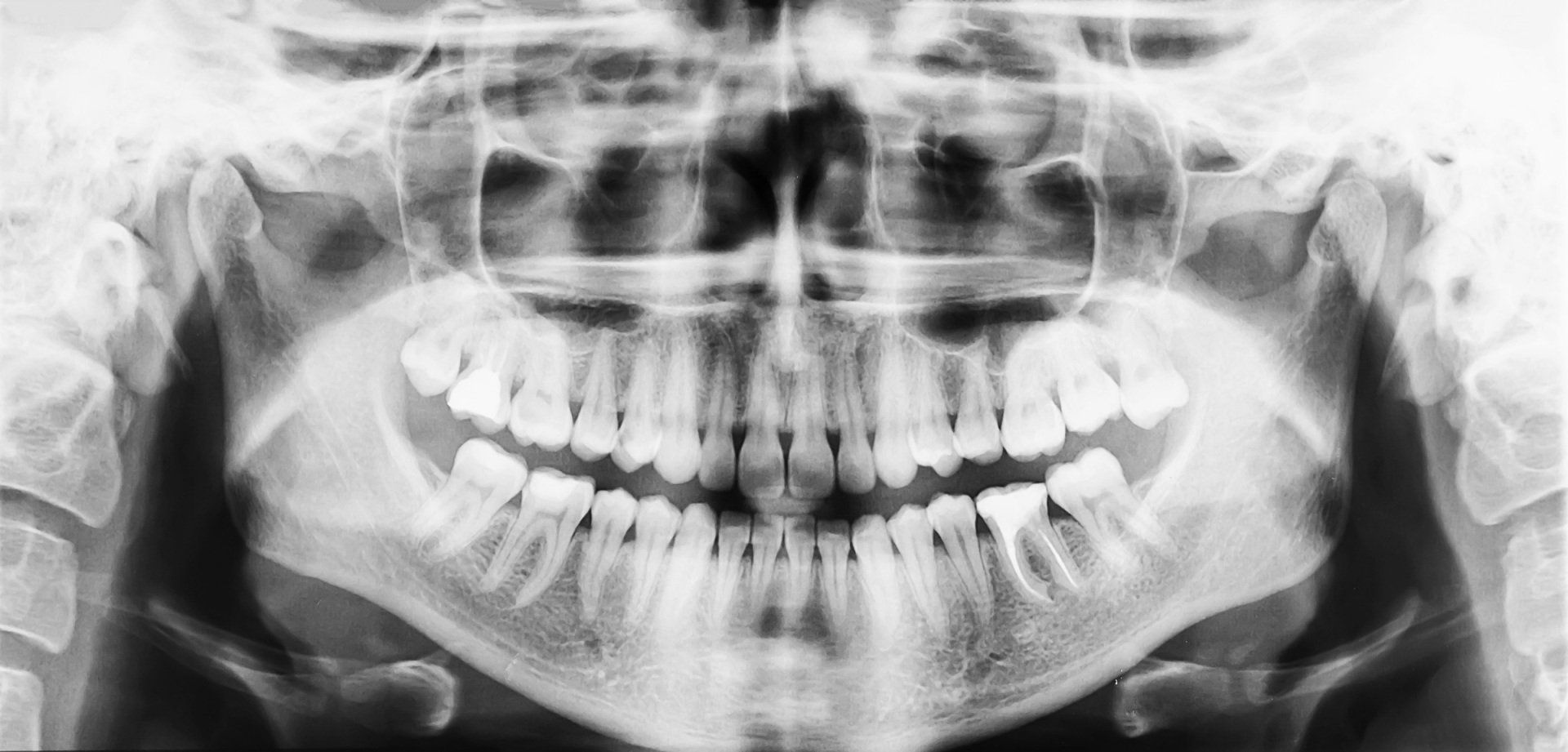 Digital X-ray
