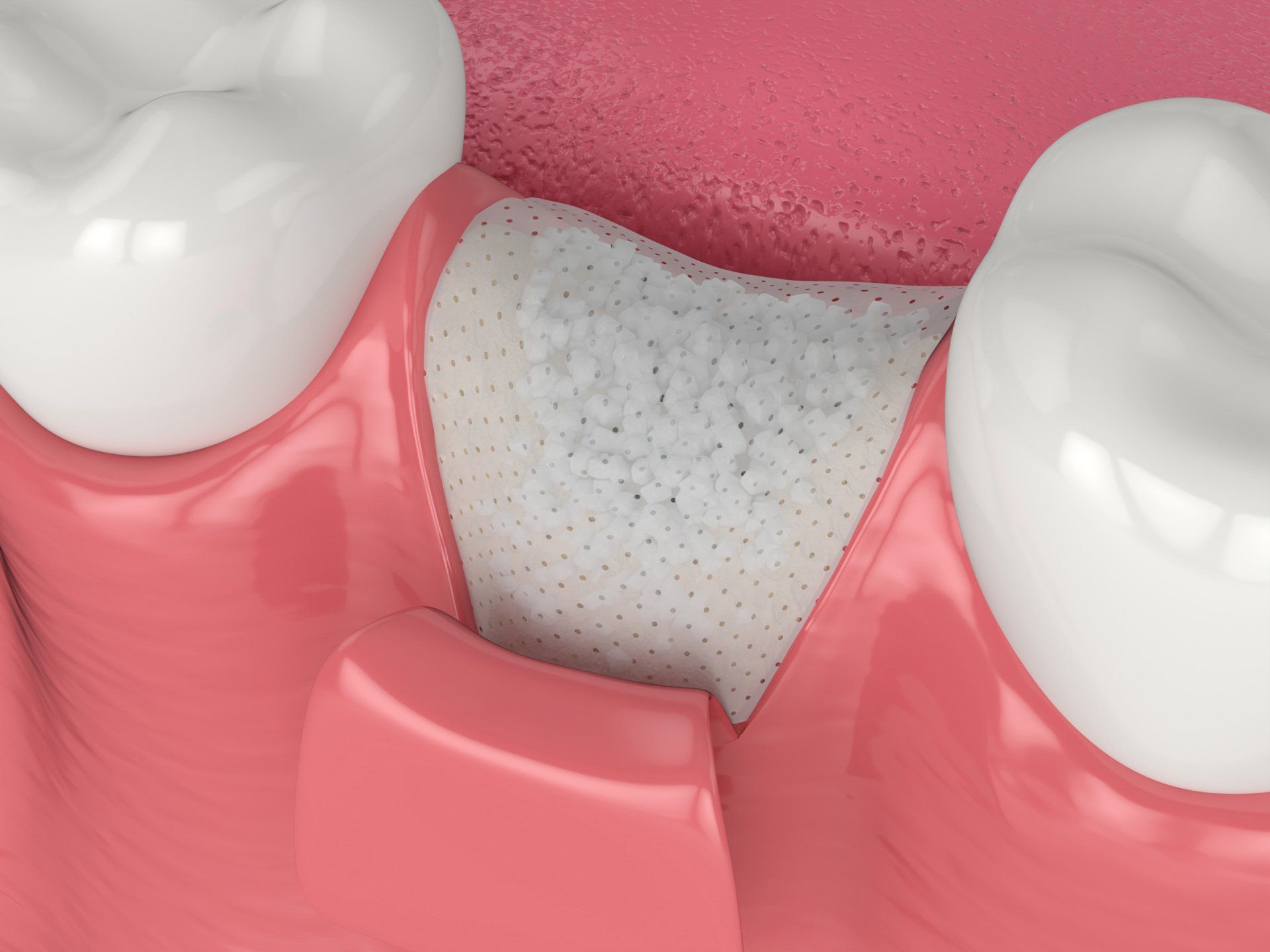 CGI bone grafting graphic