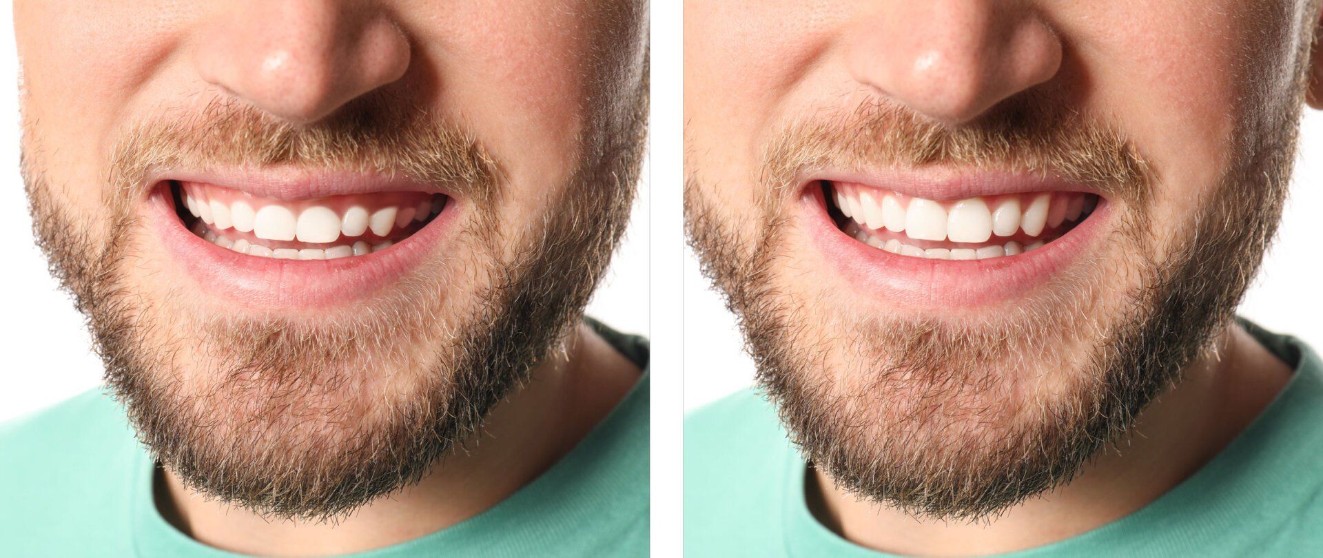 Gum contouring before and after