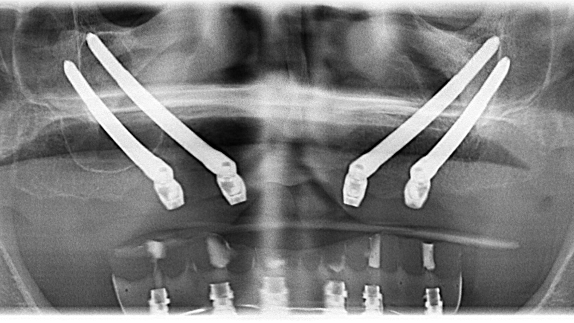 Zygoma-Implantate in Zagreb – Lösung für Patienten mit Knochenschwund im Oberkiefer (Röntgenbild)