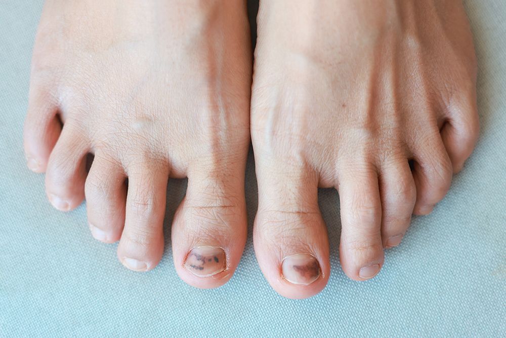 Black Toenail