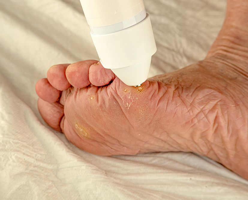 Foot Cryosurgery
