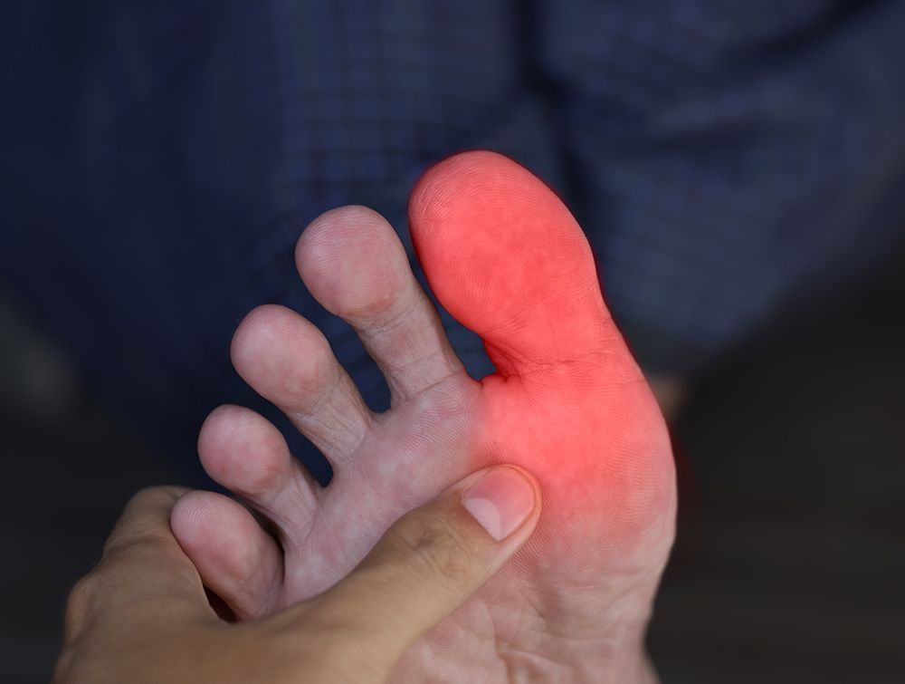 Hallux Limitus