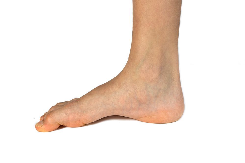 High Arched Feet