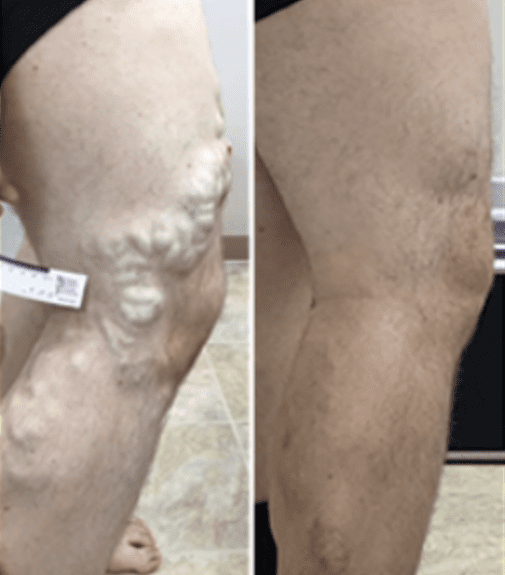 Diabetic Foot Care