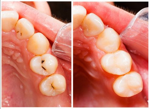 Dental cavity treatment with composite fillings in Concord Dental cavity treatment with composite fillings in Concord