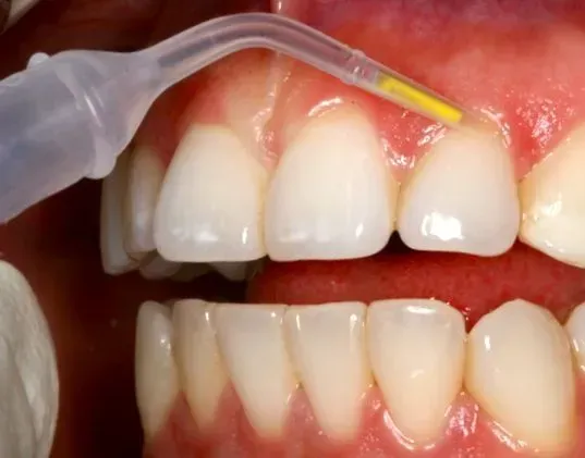 Gum health treatment with Arestin antibiotics at Central City Dentistry Gum health treatment with Arestin antibiotics at Central City Dentistry
