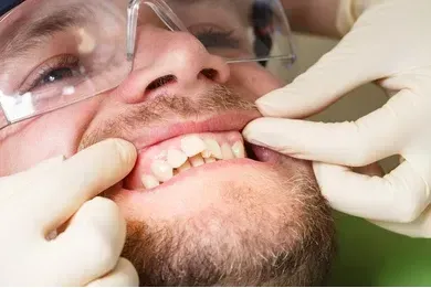 Scaling and root planing for gum health at Central City Dentistry. Scaling and root planing for gum health at Central City Dentistry