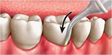 Arestin antibiotic treatment at Central City Dentistry, Concord, NH Arestin antibiotic treatment at Central City Dentistry, Concord, NH