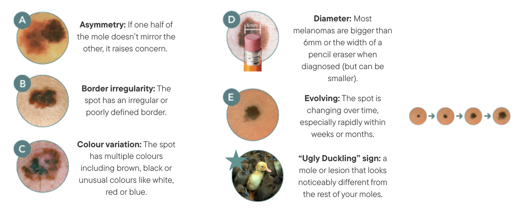 ABCDE Melanoma