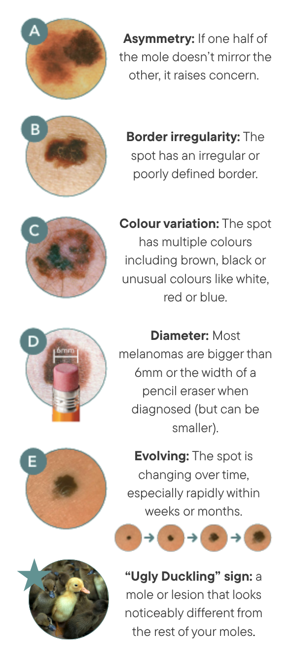 ABCDEs of Melanoma