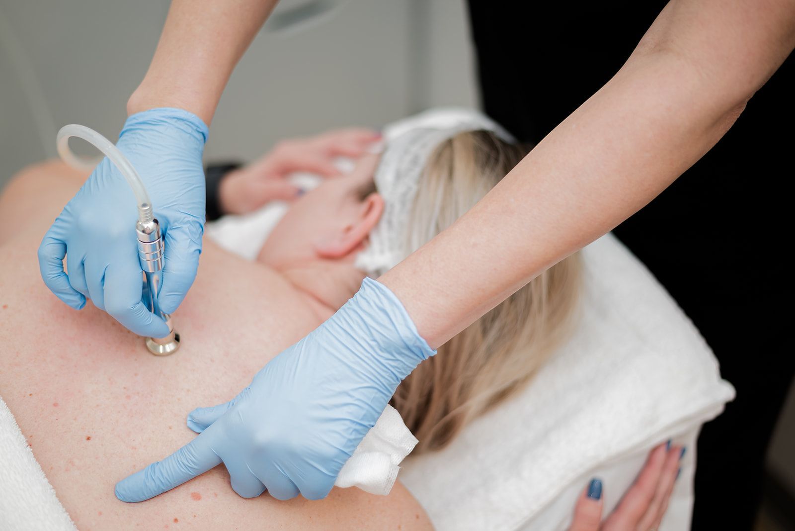Woman receiving a skin treatment on her back, conducted by a person wearing blue gloves.
