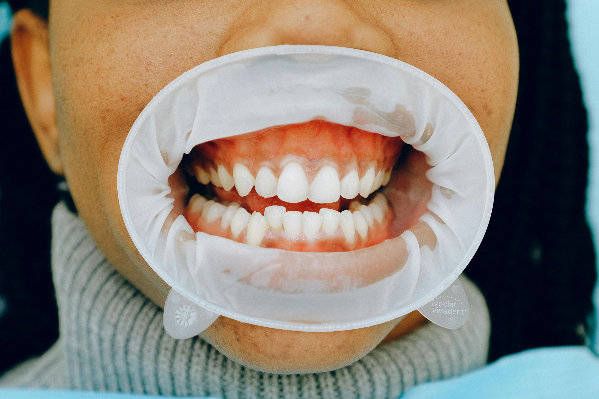 Mouth open with a dental cheek retractor, showing teeth.