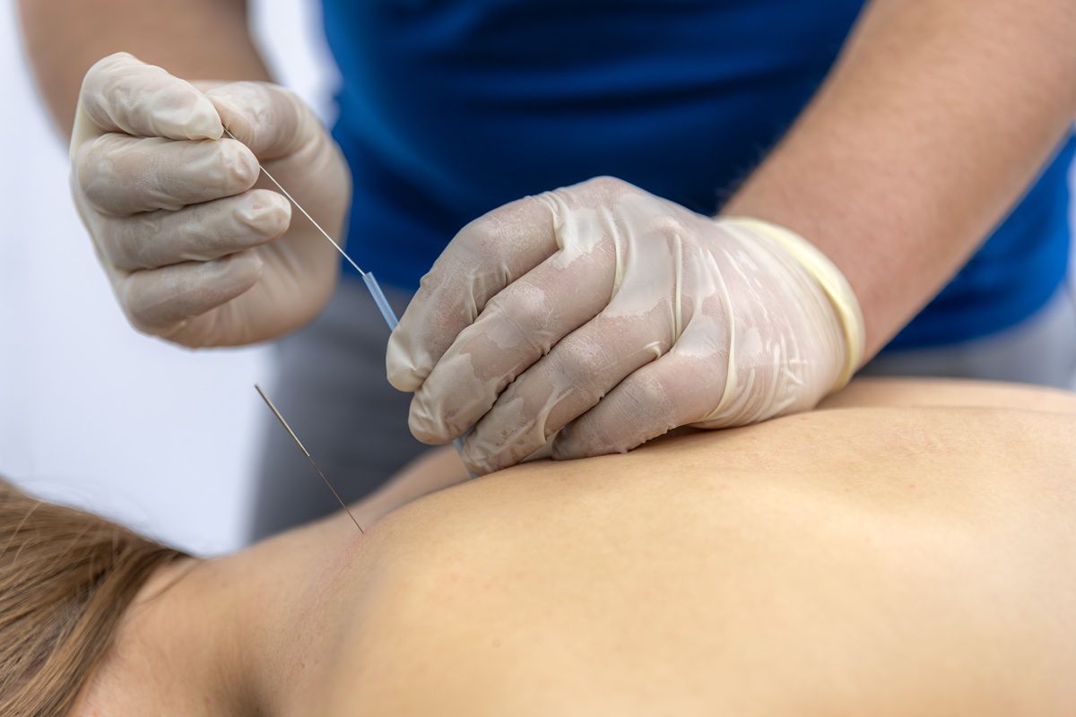 A practitioner in blue clothing and gloves performs dry needling on a person's upper back.