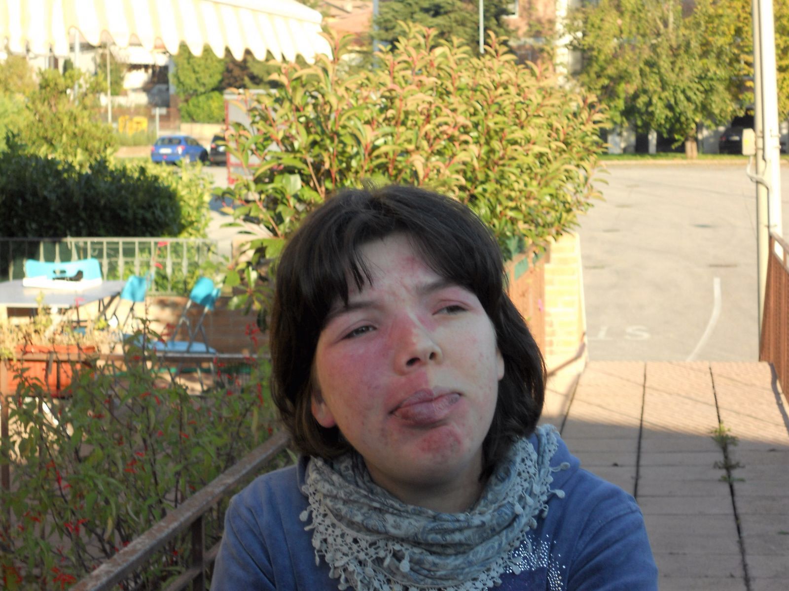 Una ragazza con la sindrome di Sturge Weber in cortile