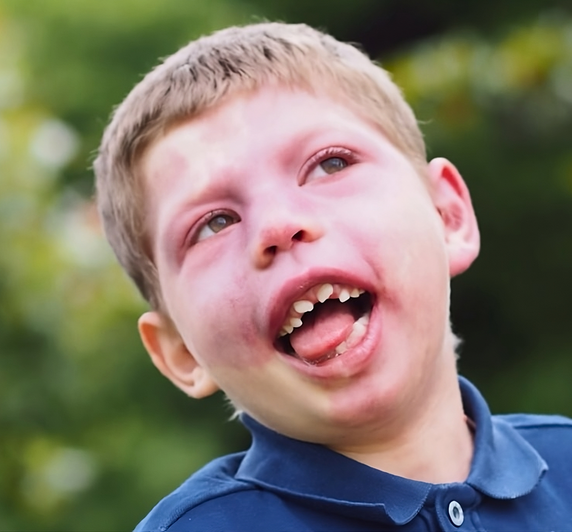 Un ragazzino con la sindrome di Sturge-Weber che sorride
