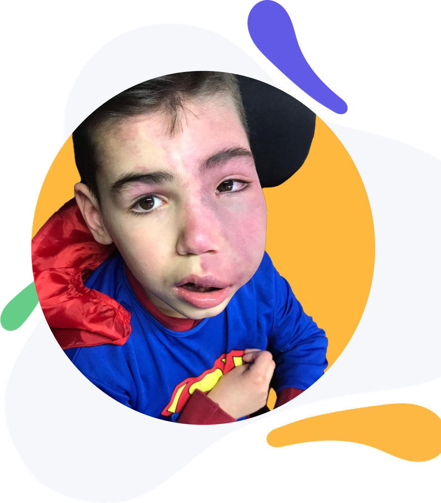 Un ragazzino con la sindrome di Sturge-Weber in costume da superman ha una macchia rossa sul viso