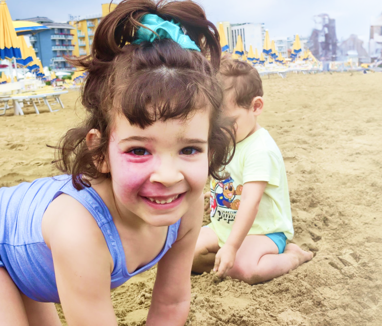 Una bambina con la sindrome di Sturge Weber che gioca sulla sabbia al mare