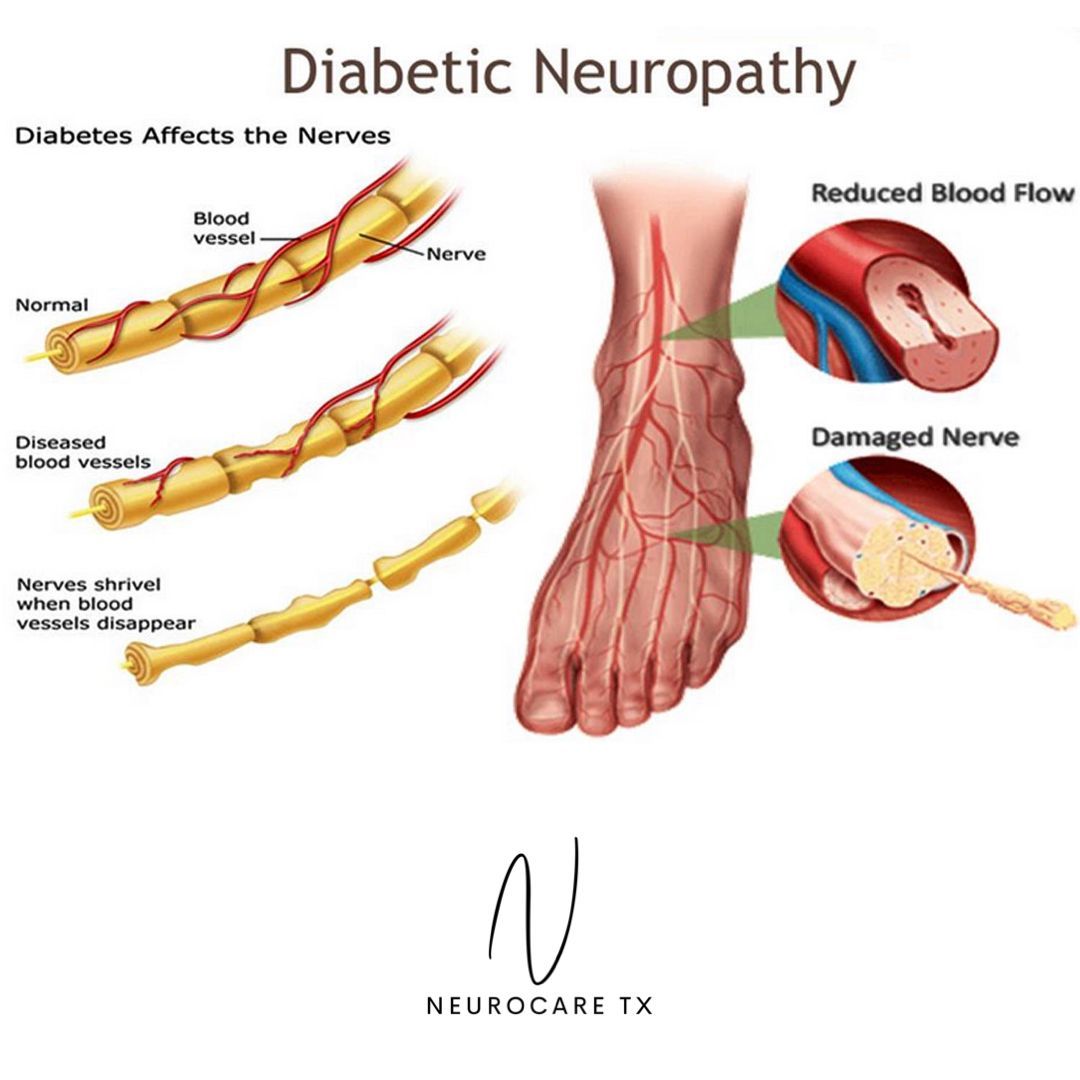 Diagram of diabetic neuropathy showing reduced blood flow and damaged nerves in the foot