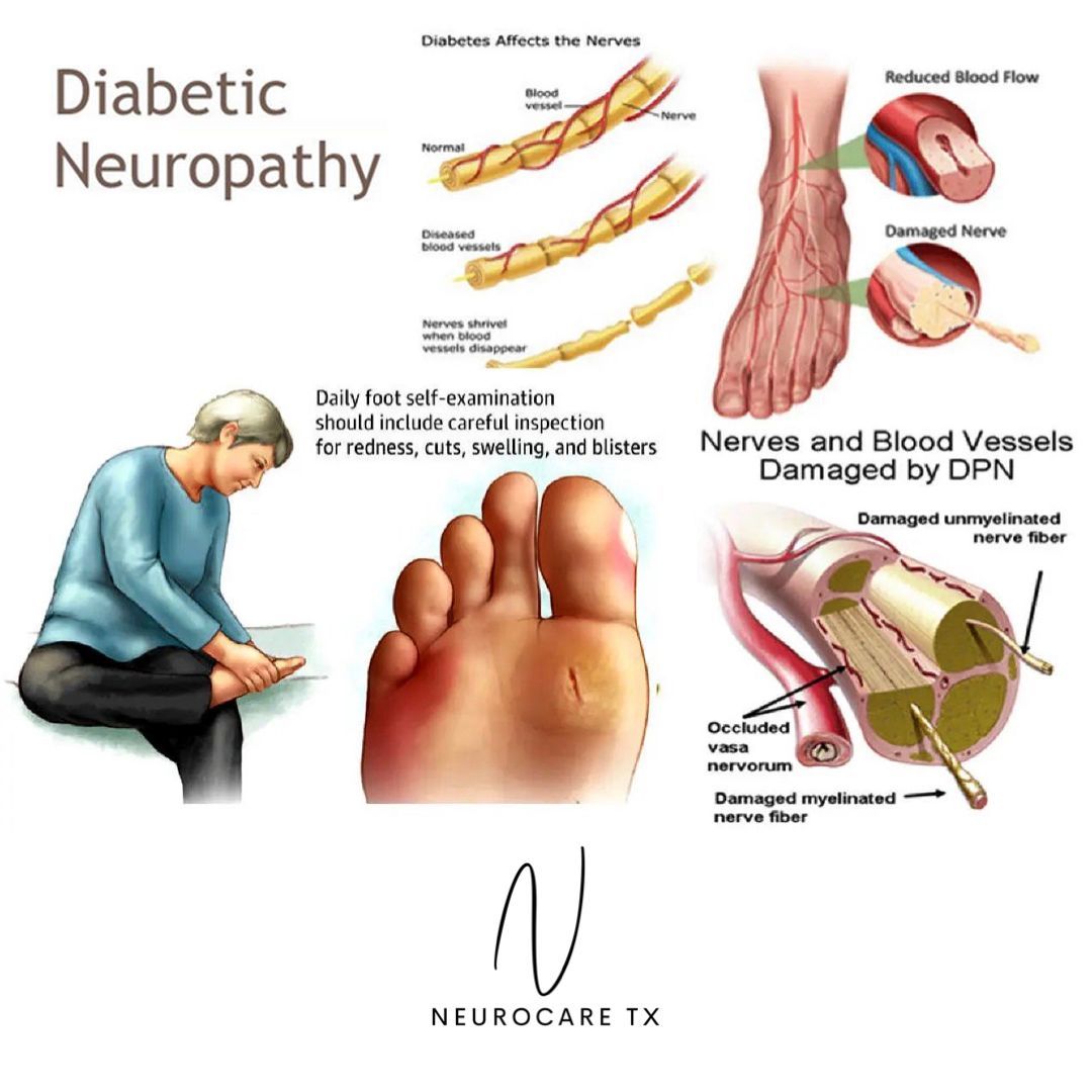 Diagram of diabetic neuropathy showing reduced blood flow and damaged nerves in the foot