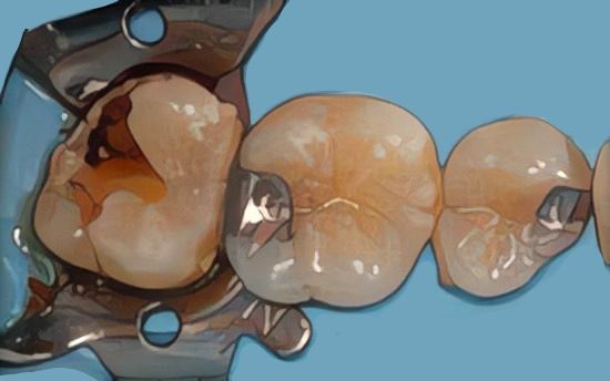tooth