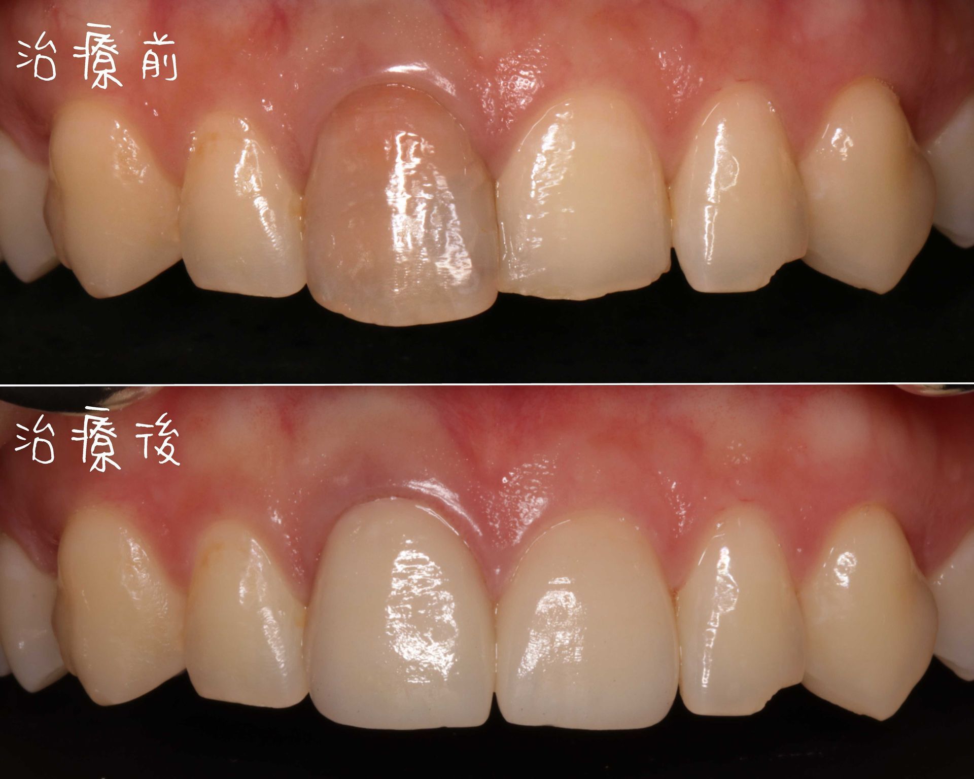 Tooth Case 1