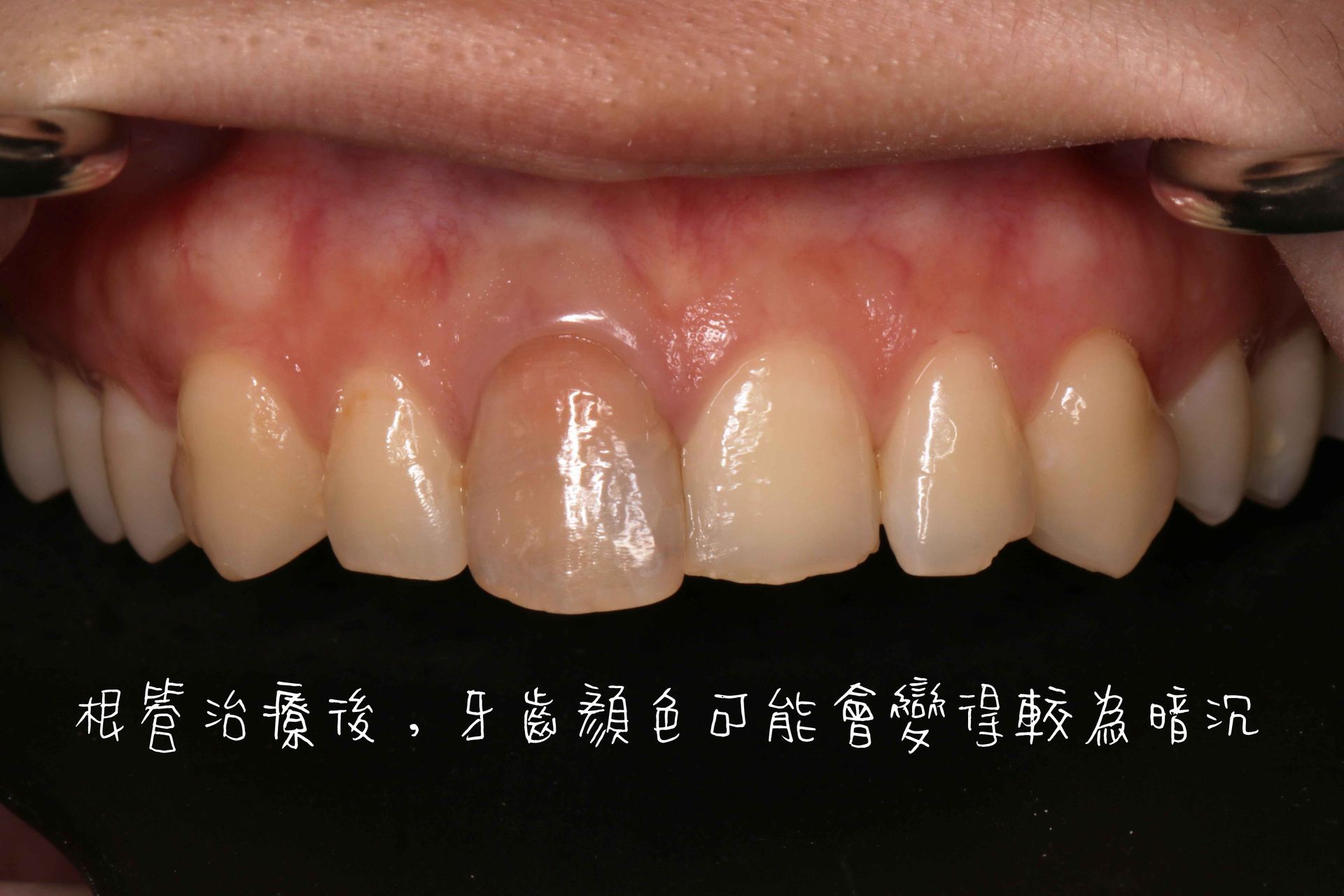 Tooth Case 1