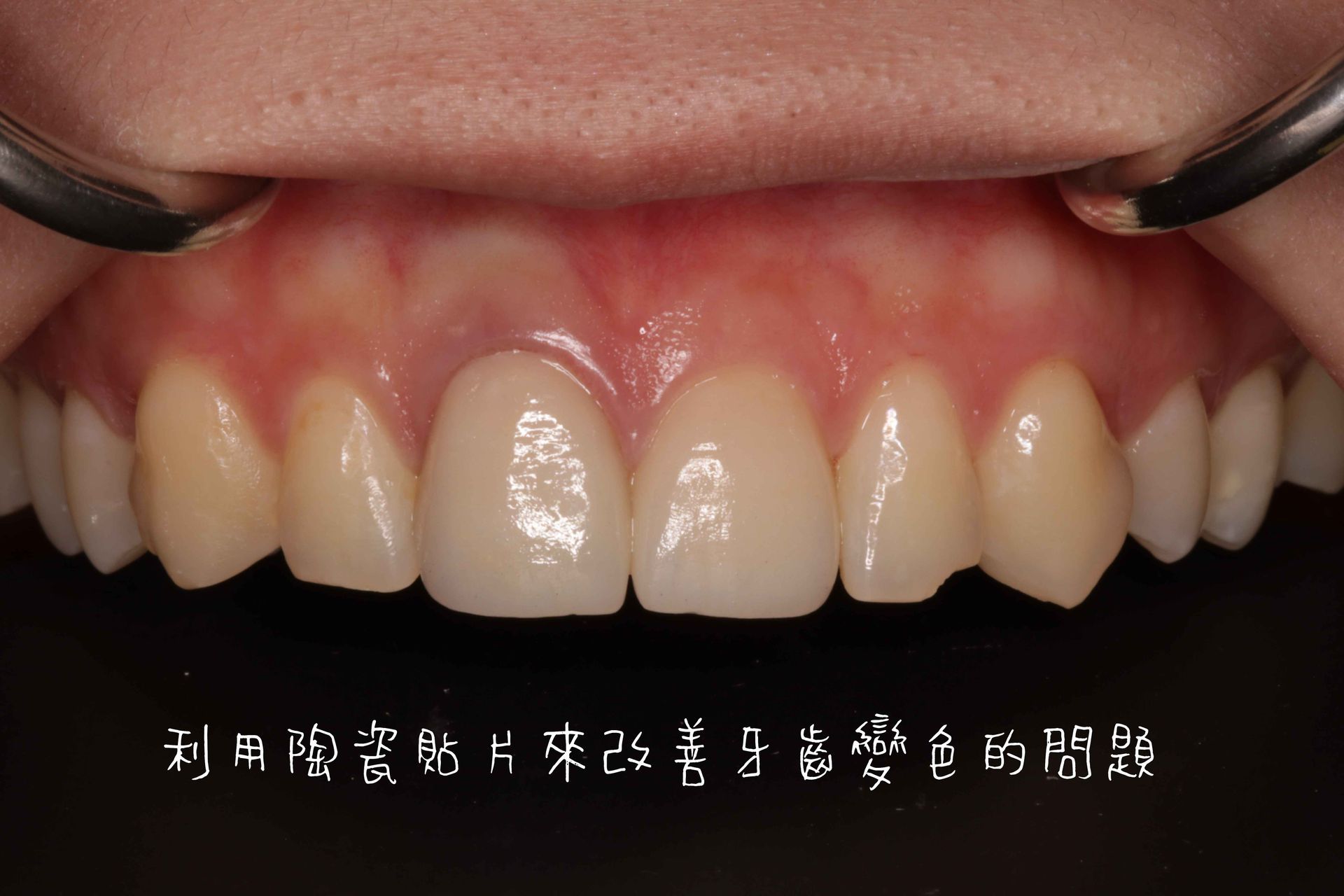 Tooth Case 1