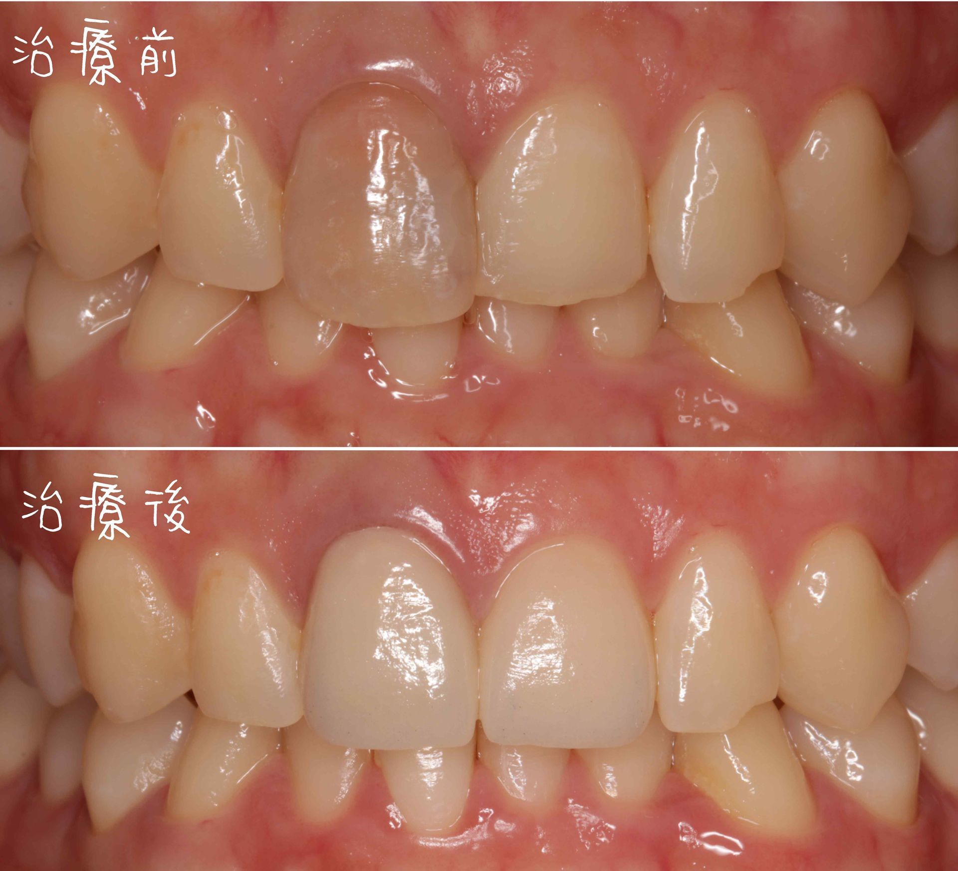 Tooth Case 1