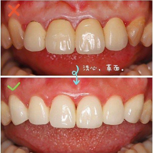 Tooth Case 2