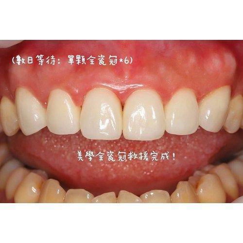 Tooth Case 2