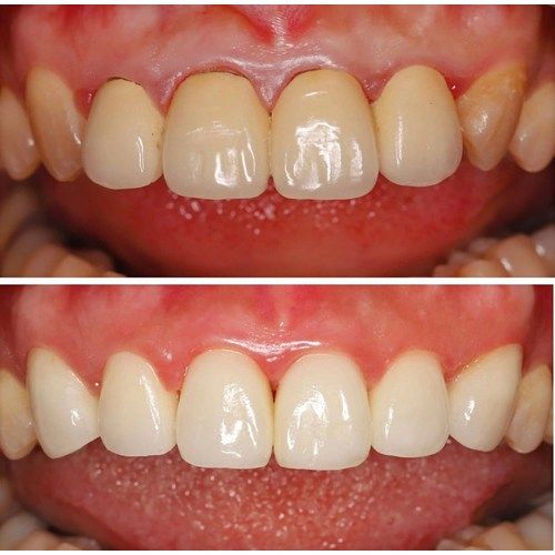 Tooth Case 2