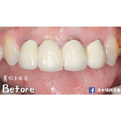 Tooth Case 3