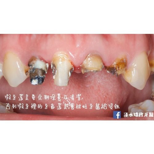 Tooth Case 3