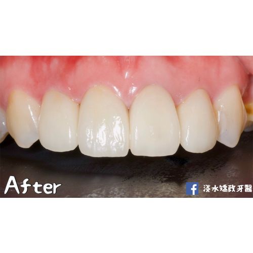 Tooth Case 3