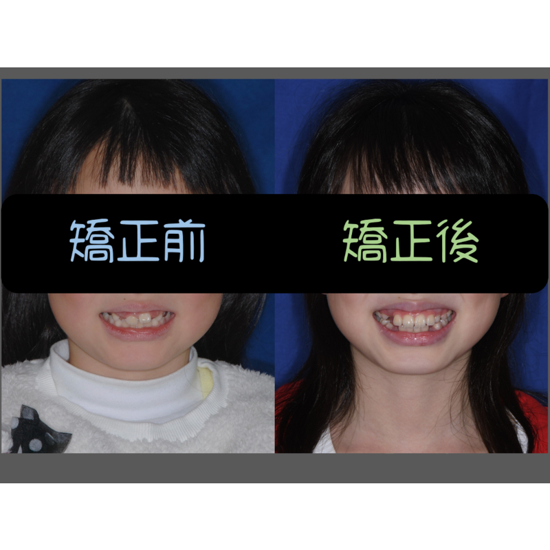 Case Five Invisalign