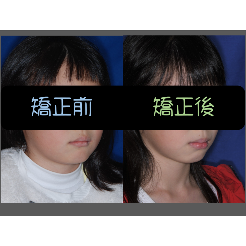 Case Five Invisalign