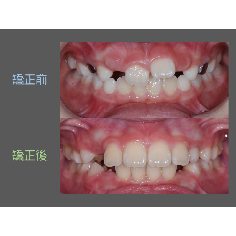 Case Five Invisalign