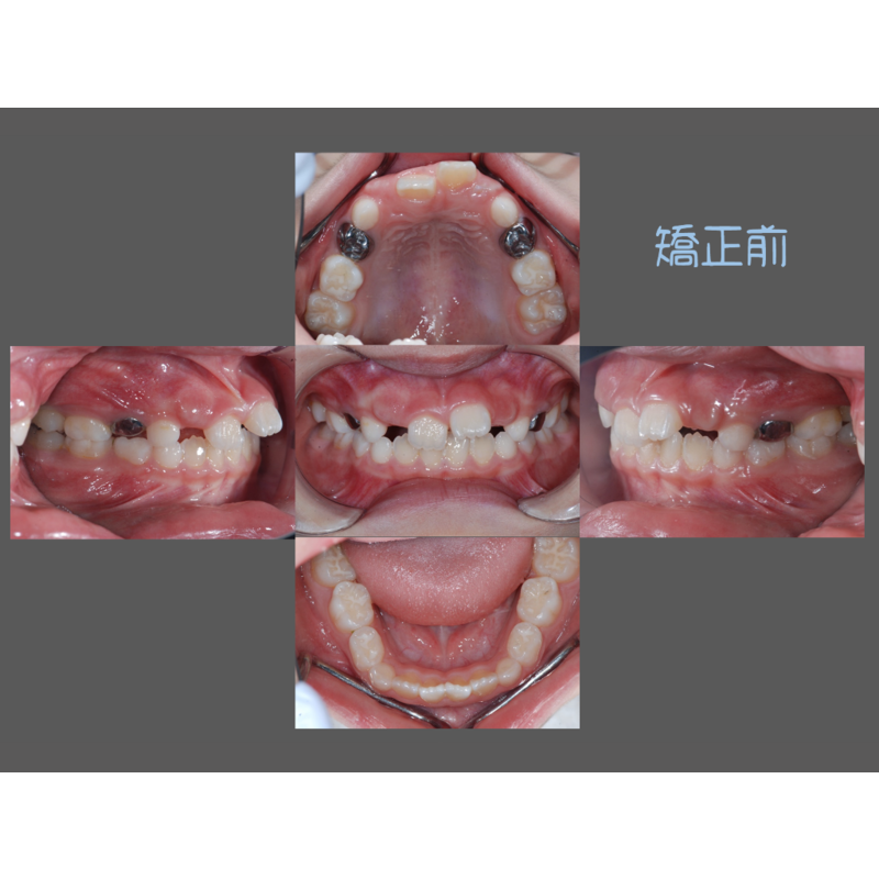 Case Five Invisalign