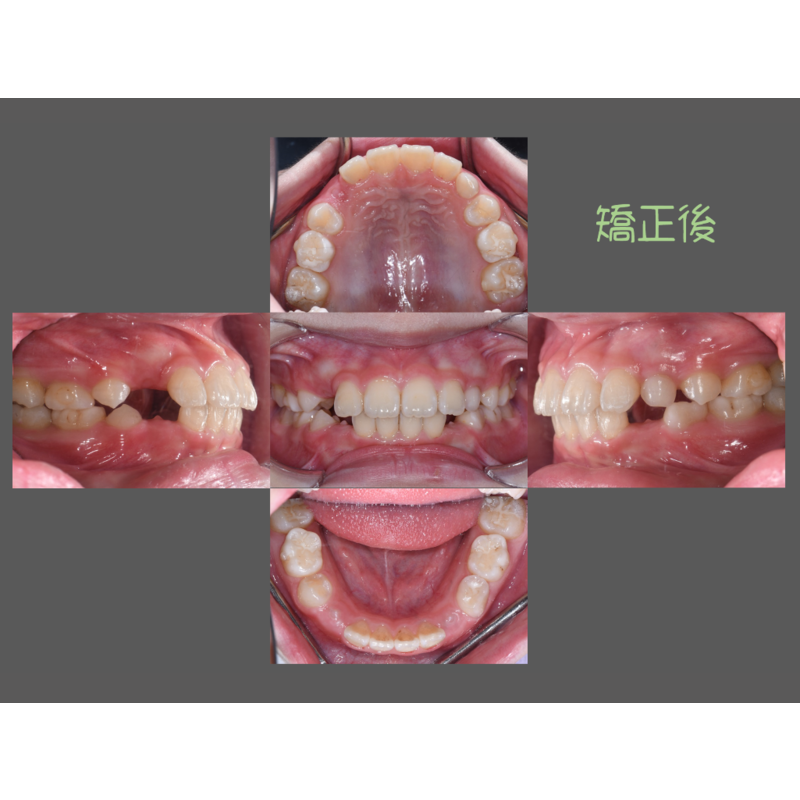 Case Five Invisalign