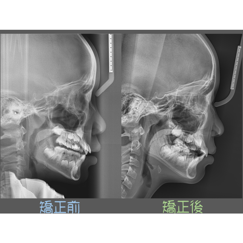 Case Five Invisalign