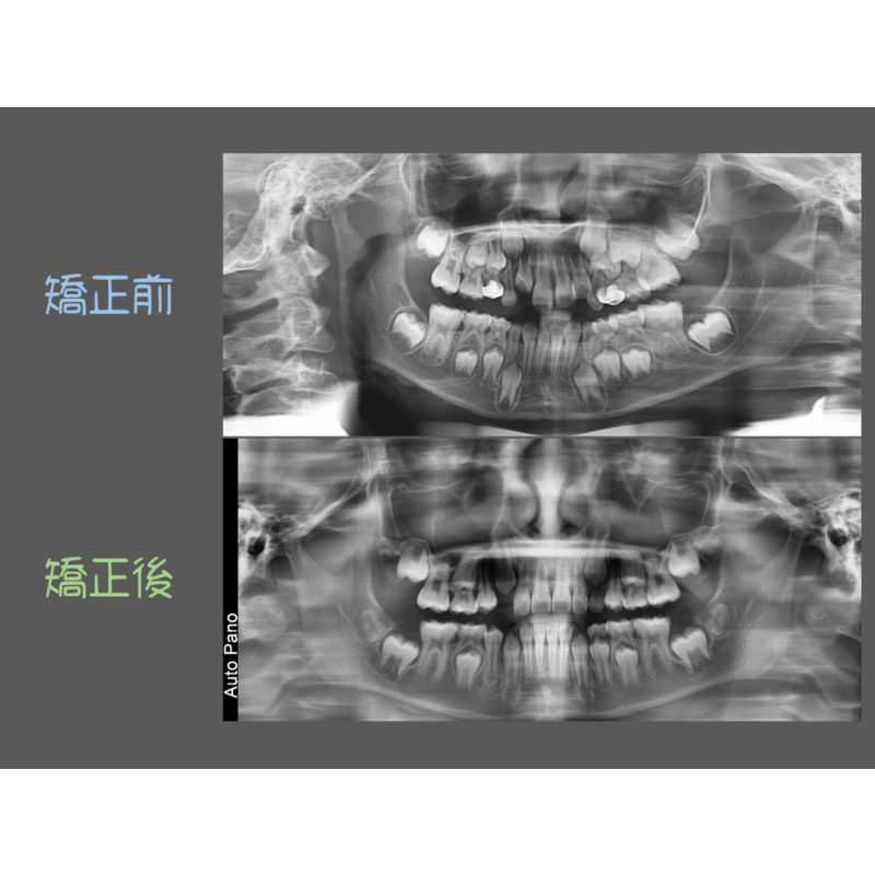 Case Five Invisalign