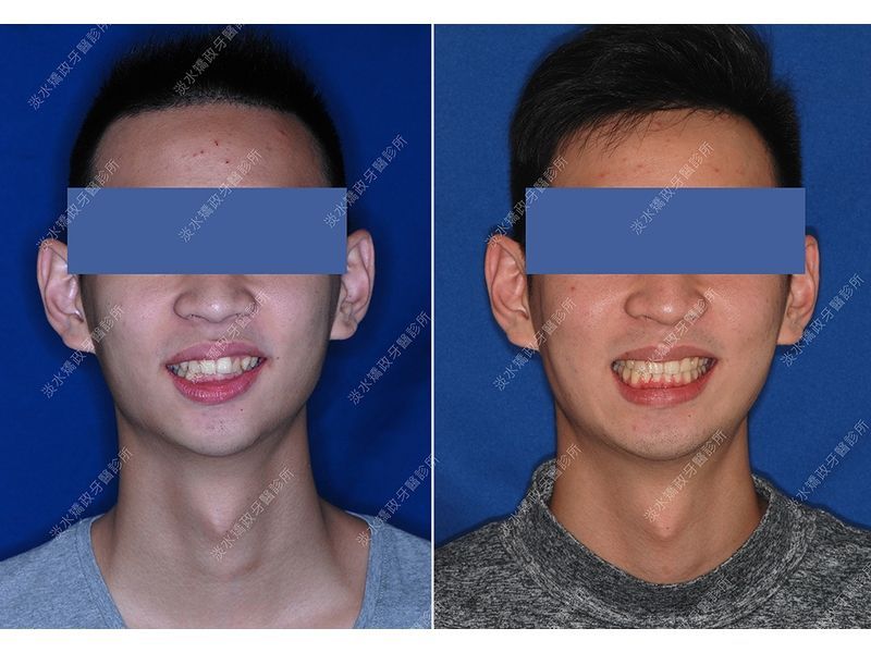 Case Five Protruding Teeth
