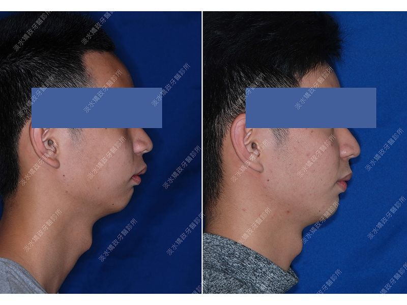 Case Five Protruding Teeth