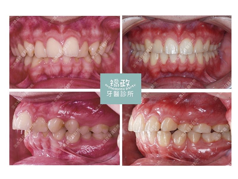 Case Five Protruding Teeth