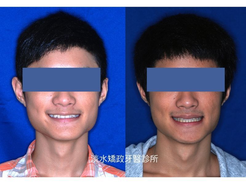 Case Five Protruding Teeth