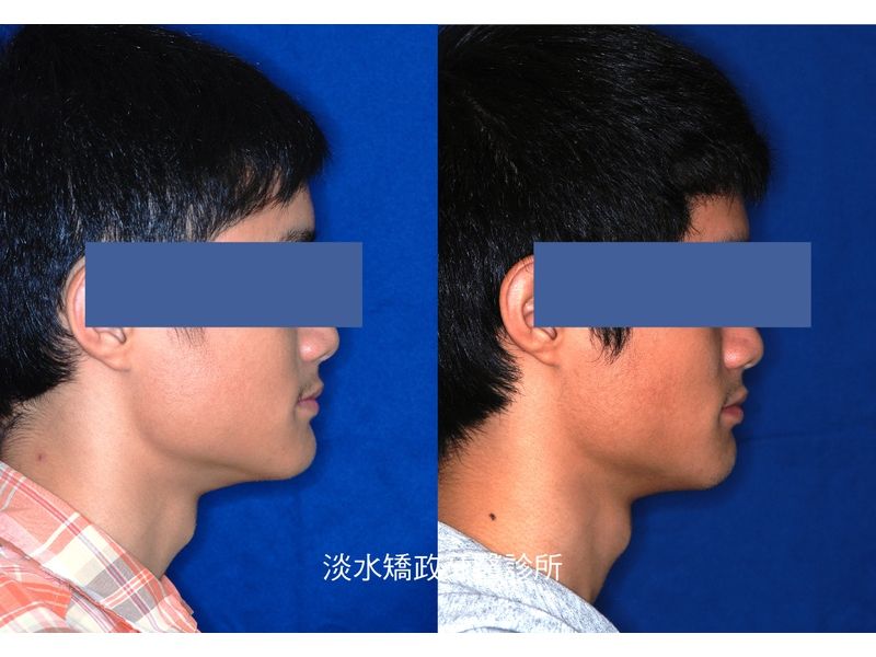 Case Five Protruding Teeth