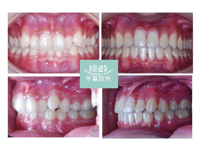 Case Five Protruding Teeth