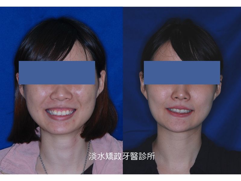 Case Five Protruding Teeth