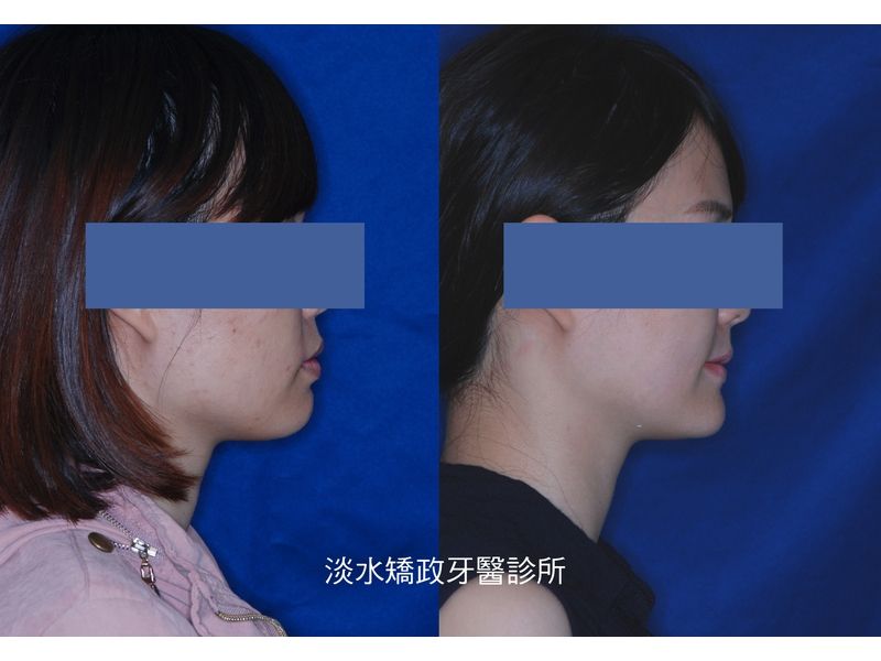 Case Five Protruding Teeth